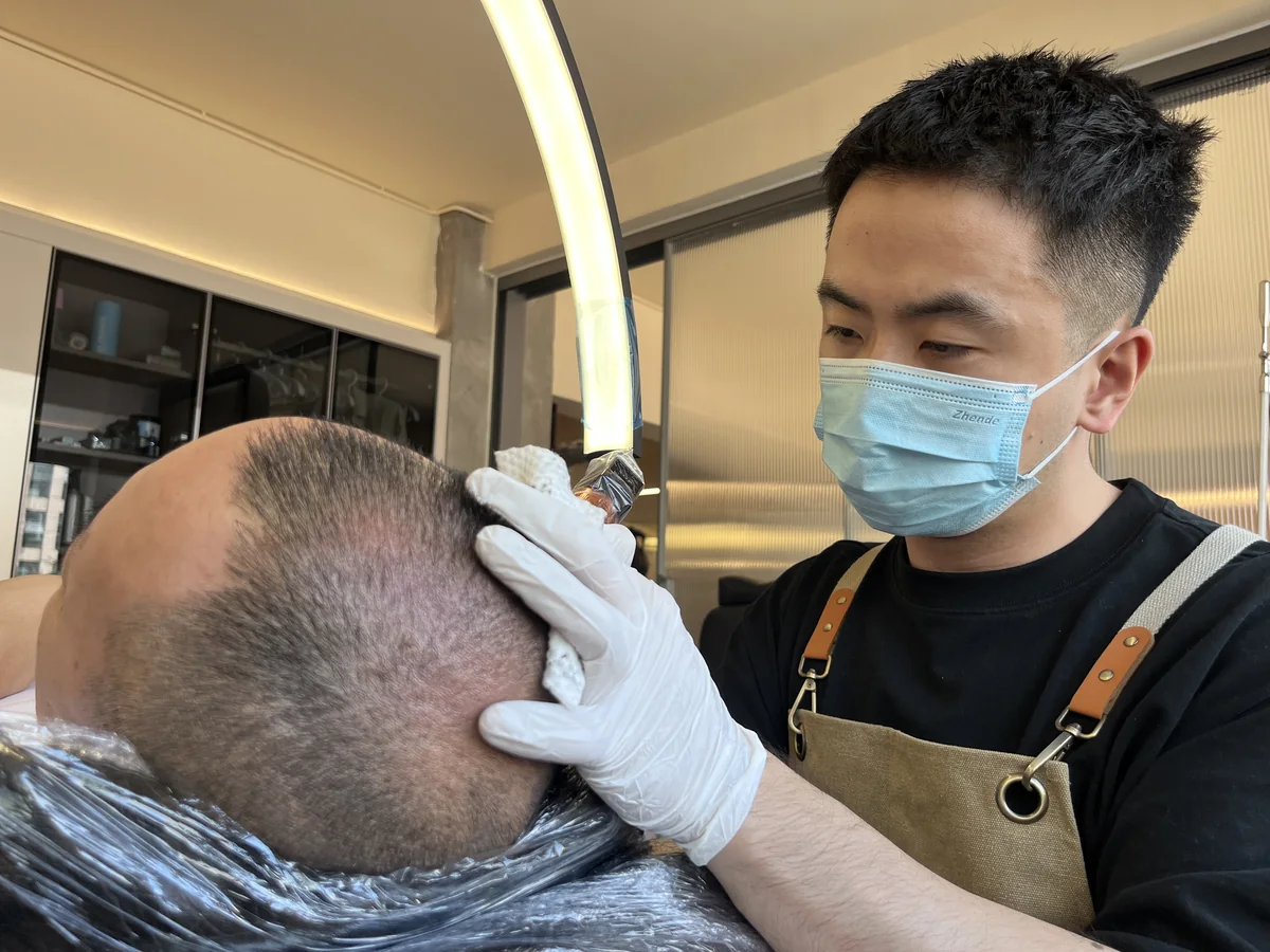 雷势北京店纹发施作实拍:头皮侧面与操作过程